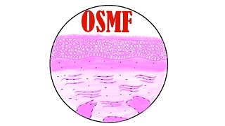 Oral Submucous Fibrosis  Histopathology [upl. by Hugo]