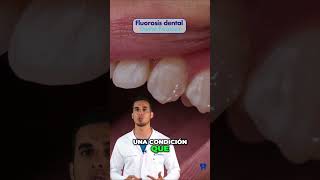 ¿Tienes MANCHAS en los dientes Podría ser FLUOROSIS dental [upl. by Rexana411]