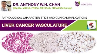 Liver Cancer Vasculature  Pathological Characteristics and Clinical Implications [upl. by Sorazal]