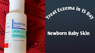 Desonide Lotion Treat Eczema in 15 Days for Newborn BabyToddler [upl. by Ahsieken]