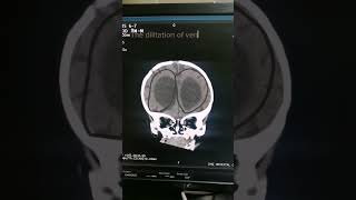 Hydrocephalus  Babay CT  Head anatomy  Findings of Head  Medical Imaging  Brain CT [upl. by Eceirahs]