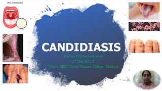 Candidiasis  Candida albicans  Pathogenesis  Clinical Manifestations  Lab Diagnosis  Treatment [upl. by Eelrihs]