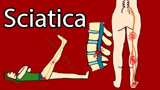 Sciatica  Onesided Leg pain and tingling Sciatica Symptoms and Treatment Radiculopathy [upl. by Sherie]