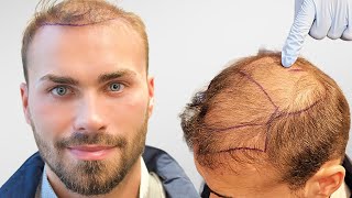 Chris hat es wieder getan Zuerst FUT jetzt FUE Haartransplantation  Erfahrung und Vergleich [upl. by Haynes]