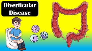 Diverticular Disease And Diverticulitis  Causes Signs amp Symptoms Diagnosis Treatment [upl. by Ateekal74]