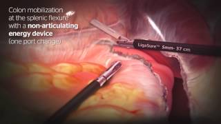 ENSEAL G2 Articulating Tissue Sealers  MDEA 2014 Finalist [upl. by Stelmach]