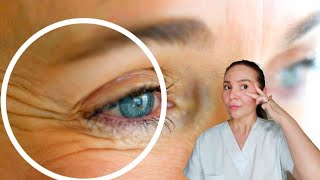 How to reduce under eye wrinkles  Wrinkles around the eyes Crowsfeet [upl. by Nuncia421]