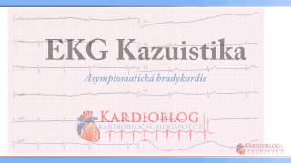 Kardioblog  EKG Kazuistika Asymptomatická bradykardie [upl. by Atterg]