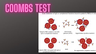 Coombs test or anti human globulin test for differentiating immune hemolytic anemia [upl. by Polk]