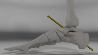 Over Pronation amp Supination Motion Biomechanics of the Subtalar Joint Explained [upl. by Cristin]