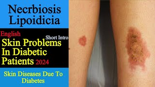 Nacrobiosis Lipoidica I Diabetes Necrobiosis Lipoidica I ADSi [upl. by Luna]