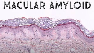 Macular amyloid keratin derived amyloid  NOT systemic amyloidosis pathology dermpath [upl. by Imoin959]