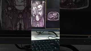 Mri enterography first time nakagawa nito [upl. by Phemia]