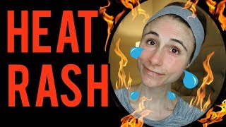 Dermatologists tips for heat rash Dr Dray 🔥🔥 [upl. by Chuck]