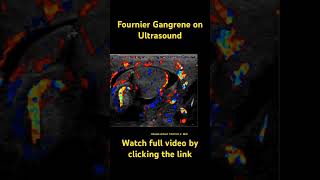 Fournier gangrene radiology radiologyresident medicine ultrasound dermatology [upl. by Arlyne]