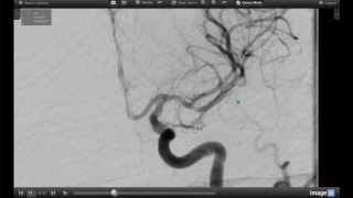 How Endovascular Stroke Treatment Works [upl. by Denzil]