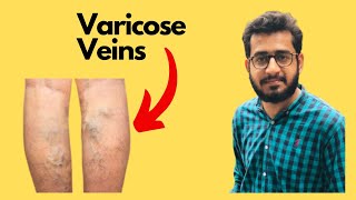 What are Varicose Veins How varicose veins form  Treatment for Varicose Veins  Best exercises [upl. by Tnilf217]