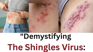 quotDemystifying the Shingles Virus [upl. by Annalise]