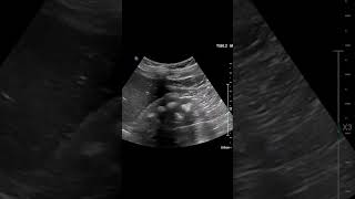 Medullary Nephrocalcinosis ultrasound kidney cases nephrology [upl. by Odlawso]