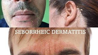 Seborrheic dermatitis  treatment health [upl. by Leahci]