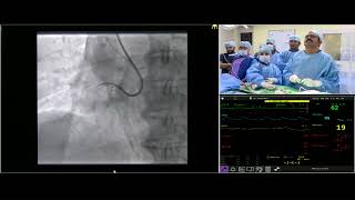 CTO live Case 3  Dr Dilip Kumar Cardiologist [upl. by Nediarb242]