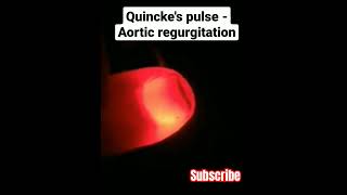 Quinckes Sign medicine clinical [upl. by Colby]