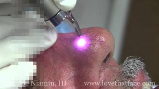 Laser Facial Spider Vein Treatment with Demonstrated by Dr Joe Niamtu III [upl. by Eanal955]