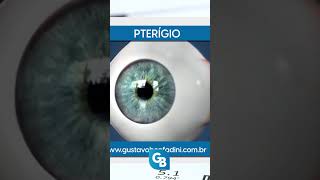 CATARATA VS PTERÍGIO saúdeocular oftalmologista [upl. by Hansen81]