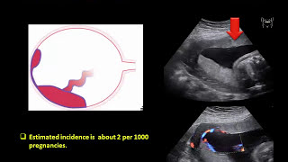 Ultrasound Imaging of the placenta Part 1 Anatomy and Variants [upl. by Einnoj]