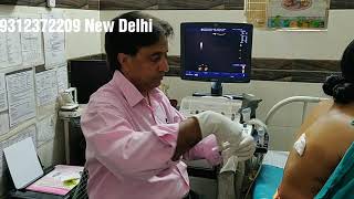 Pleural Fluid Aspirations under Ultrasound Guidanceछाती से TB पानी निकालने का तरीका [upl. by Ott]