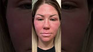 Before amp After the CO2 Laser Treatment antiaging lasertreament [upl. by Mcgill]