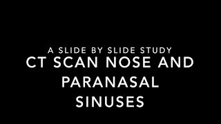 HOW TO read CT scan of Nose and Paranasal sinus a slice by slice illustration [upl. by Ahsilac810]