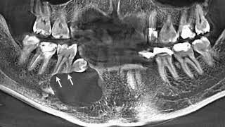 Enucleation of dentigerous cyst  dentistry  surgery  cyst  supernumerary teeth  amazing [upl. by Lan623]