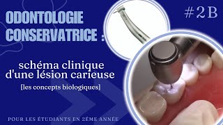 odontologie conservatrice  schéma clinique dune lésion carieuse part2 [upl. by Kirsch]