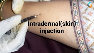 intradermal or skin injection [upl. by Farand523]