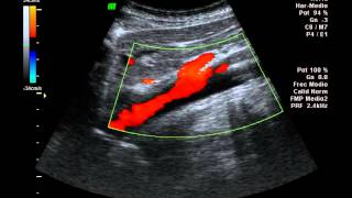 Aorta abdominal Doppler Color [upl. by Dent83]