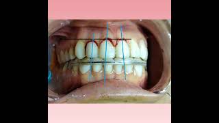 Gingivectomy after 10 days [upl. by Lothair]