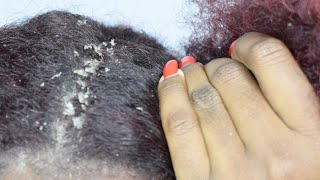 ITCHY DRY SCALP  SCRATCHING DANDRUFF [upl. by Noivaz]