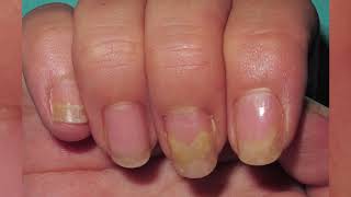 What is nail psoriasis pictures images photos on fingernails and toenails [upl. by Giulia]