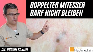 Doppelt endender Mitesser Darf nicht bleiben  Dr Kasten Hautmedizin in Mainz mitesser [upl. by Attenyw559]