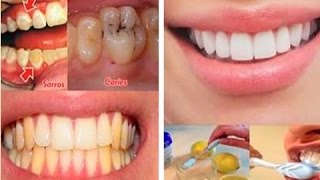 Eso Que Ves Eran Mis Dientes Con Caries Y Amarillos Pero Con Esta Receta Los Puse Mejor [upl. by Eldrid7]