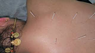 Acupuncture for Fibromyalgia fibromyalgia imwell yoga Acupuncture [upl. by Adnoval]