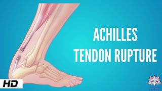 Achilles tendon rupture Causes Signs and Symptoms Diagnosis and Treatment [upl. by Novia]