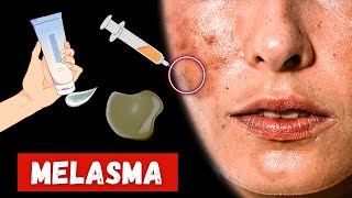 How to Treat Melasma Patches On Your Face [upl. by Marmawke]