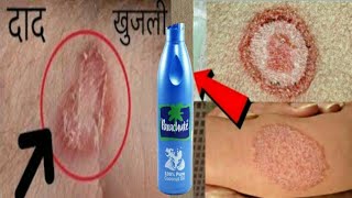 सिर्फ 2 दिन में दाद खाज खुजलीEczemaको जड़ से खत्म करेगा ये घरेलू नुस्खाringworm treatment at home [upl. by Martinic]