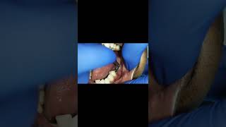 3 molar single piece implants 6 months post healing tapping test shorts [upl. by Anson374]