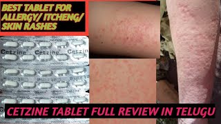 BEST TABLET FOR ALLERGY AND SKIN RASHES AND ITCHINGCETZINE TABLET USES DOSE FULL REVIEW IN TELUGU [upl. by Pattie]