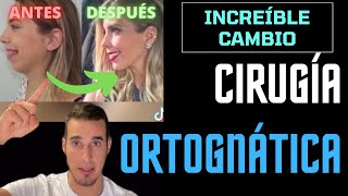 CAMBIÓ su CARA por completo  CIRUGÍA ORTOGNÁTICA [upl. by Aliuqehs]