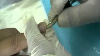 subungual thorn removed with ring block anaesthesia [upl. by Claudia]