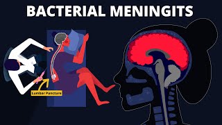 Bacterial Meningitis  Symptoms Diagnosis Treatments amp Pathology [upl. by Aicylla]